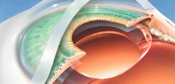Conheça a Cirurgia de Catarata com lente Intraocular por facoemulsificação