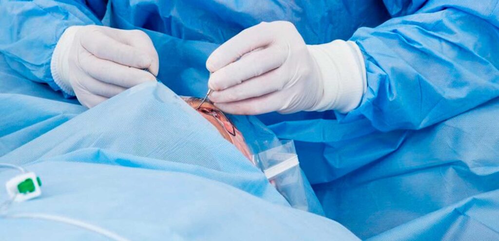 Principais dúvidas sobre a Cirurgia de Pterígio