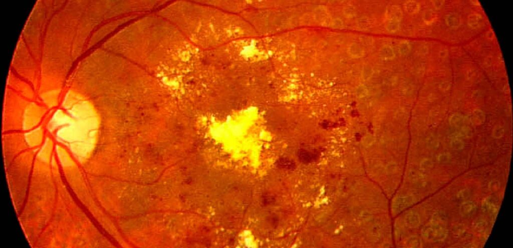 Retinopatia diabética: o que é, sintomas, causas e tratamento
