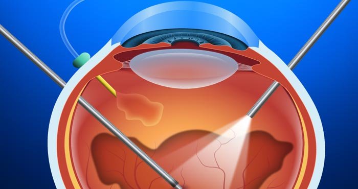Como funciona a cirurgia de implante do óleo de silicone?