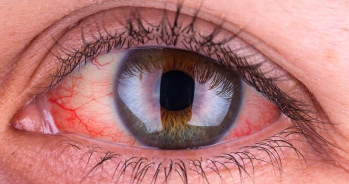 Doença que afeta os vasos sanguíneos do olho: fotocoagulação de retina