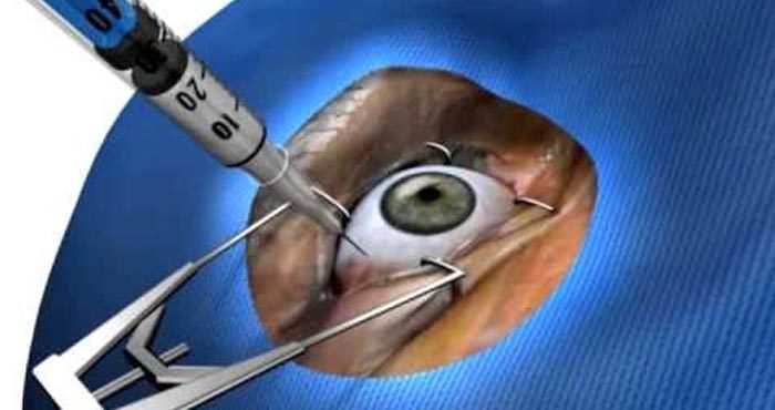 Tratamento para a retina e a injeção intra vítrea