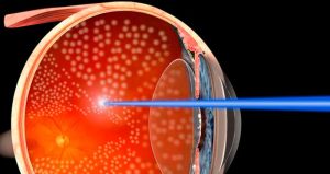 Conheça a vitrectomia: a cirurgia de retina mais utilizada atualmente