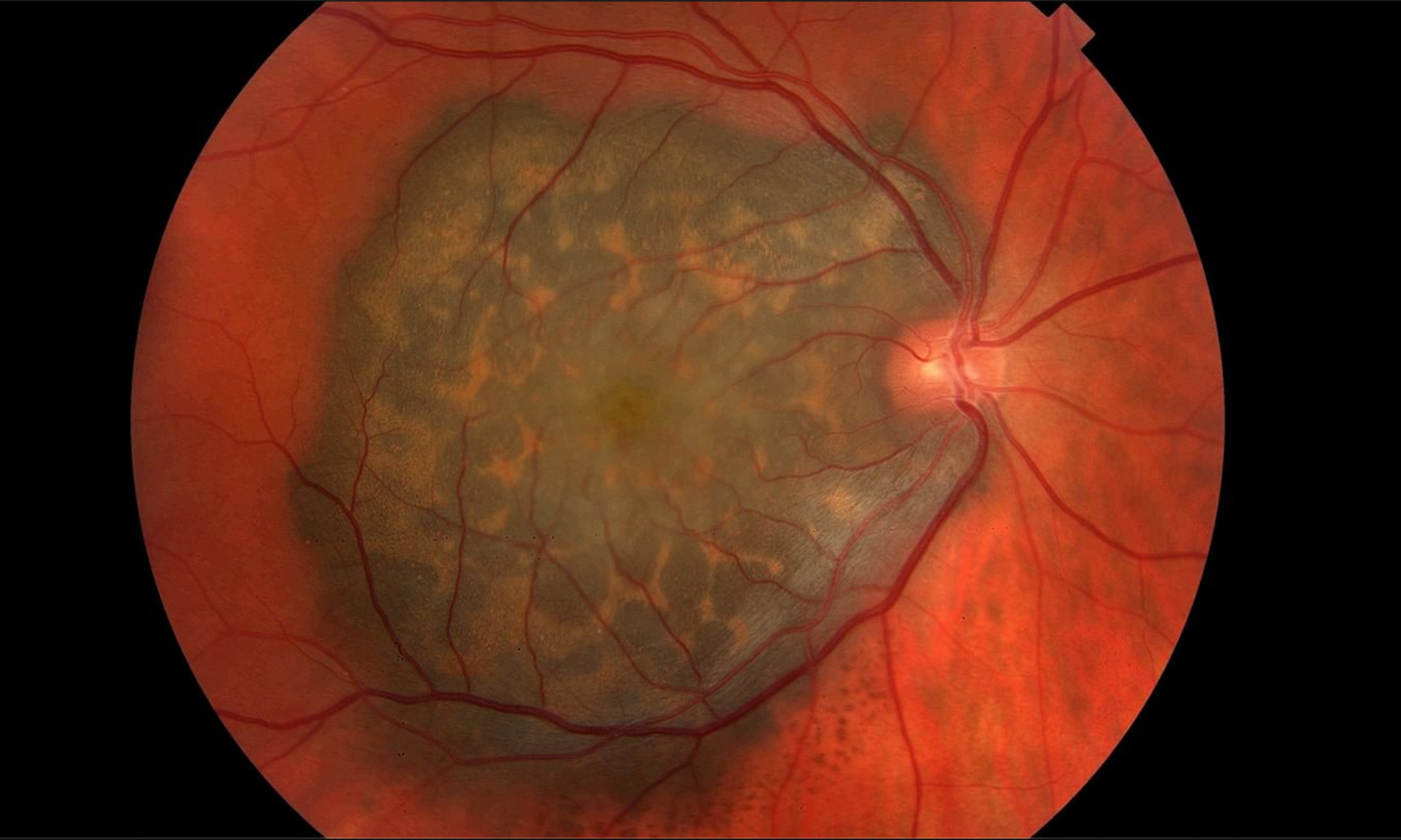 arquivos-melanoma-ocular-pr-vis-o-cl-nica-oftalmol-gica-em-macap