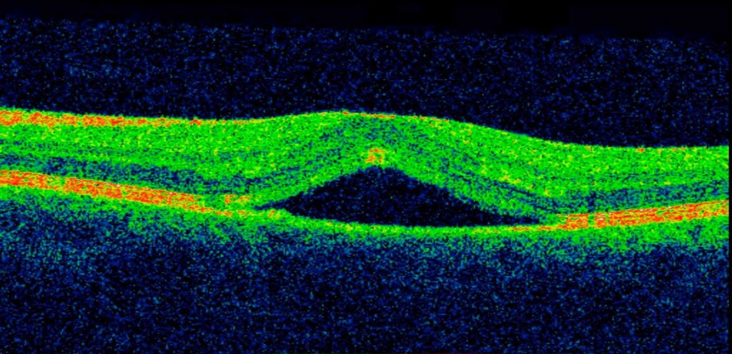 o-que-e-a-coriorretinopatia-serosa-causas-sintomas-macapa