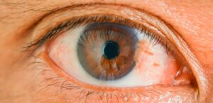 Pterígio: A doença que pode causar sérios danos a visão