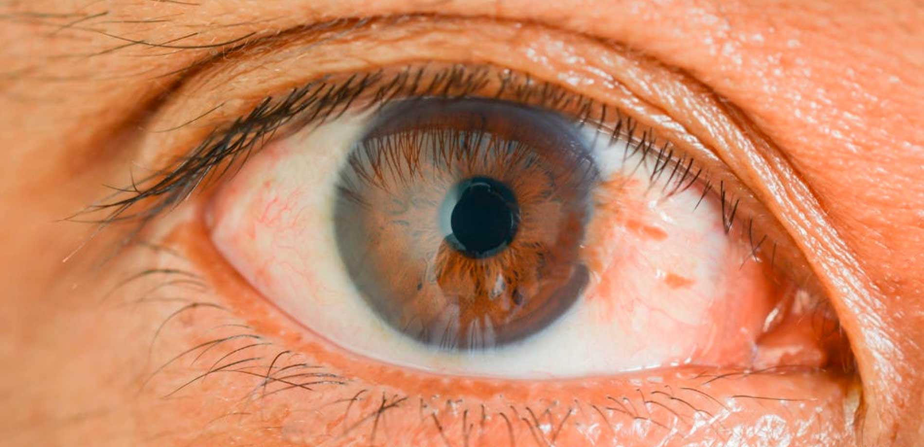 Pterígio: A doença que pode causar sérios danos a visão