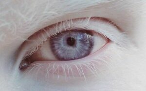 Entenda o que é Albinismo Ocular