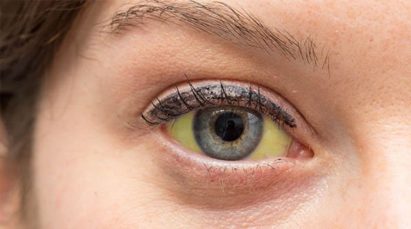 O que fazer quando meus olhos estão amarelados?