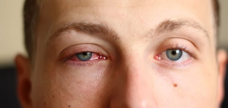 Você sabe o que é a Quemose Conjuntival?