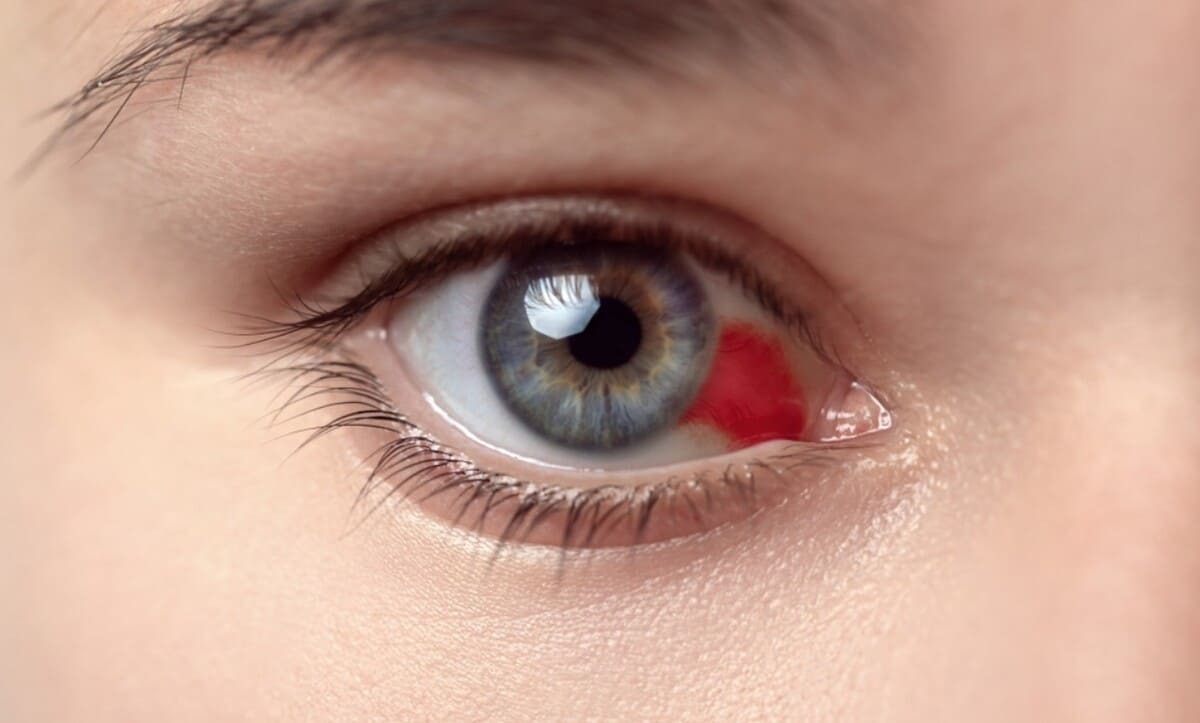 Como são os Derrames Oculares?