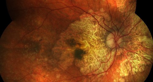 Pessoas com DMRI correm maiores riscos com o Covid-19?