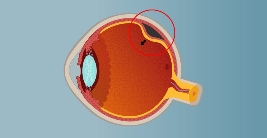O que causa o descolamento de retina?
