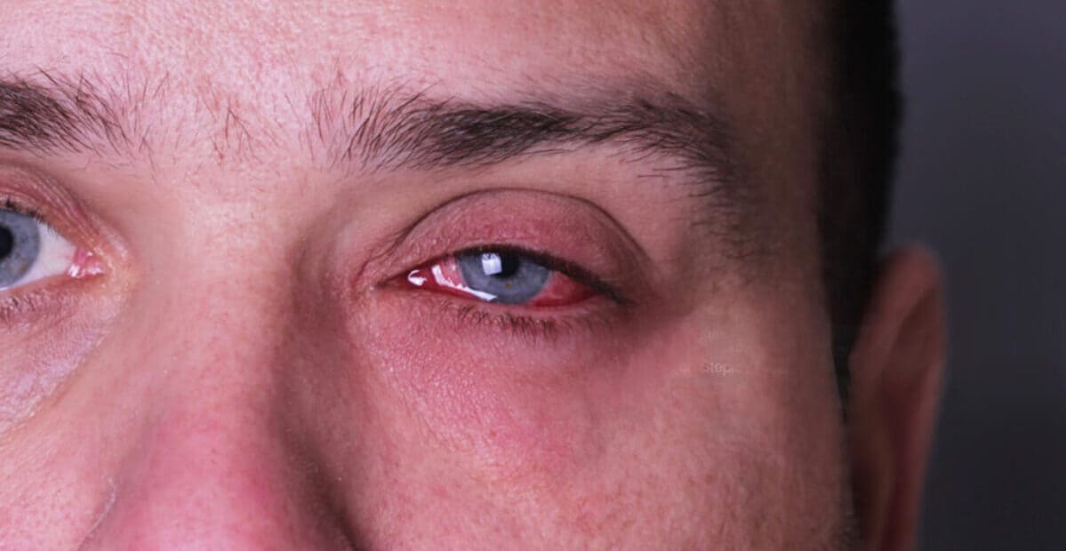5 possíveis causas dos olhos vermelhos